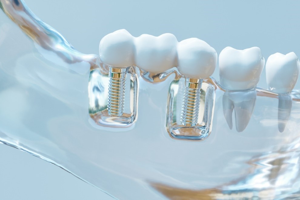 Springs shown used in dental implants